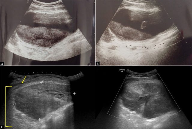 Hematoma ecografia tempo formacion 2.jpg